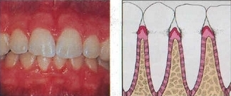 Zahnfleischentzündung - Gingivitis